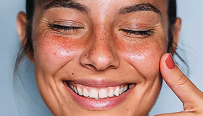 Rosacea: fenotypy, spou&scaron;těče a p&eacute;če 
